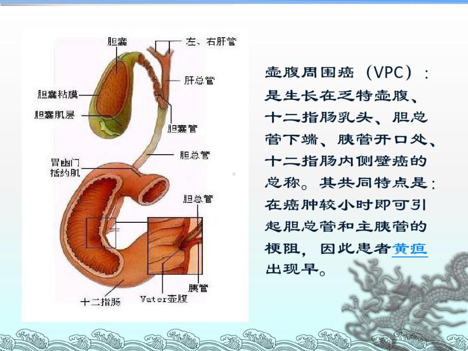 壶腹周围癌病例讨论共26张课件.ppt_第2页