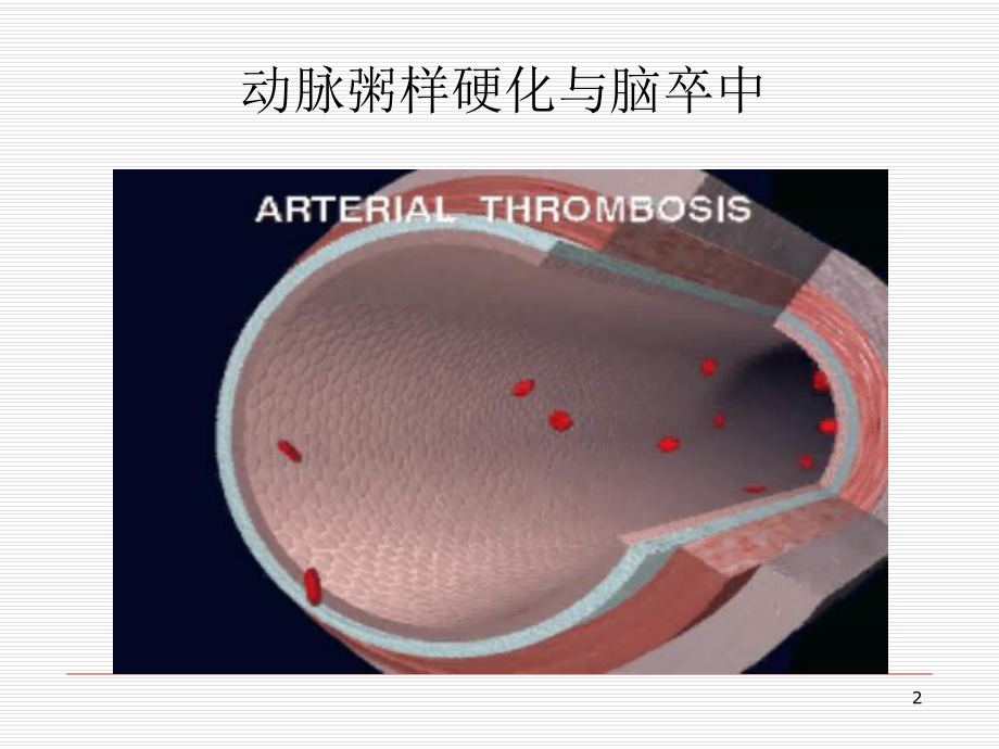 动脉到动脉栓塞性脑梗死的诊断和处理课件.ppt_第2页