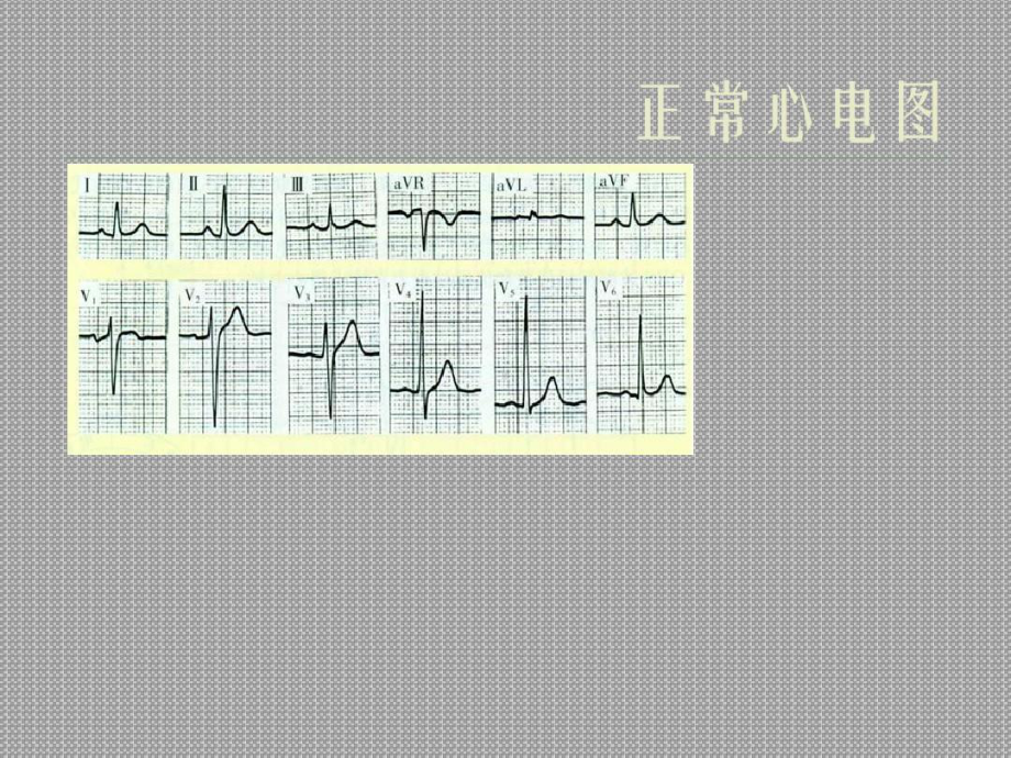 内科学诊断学重点心电图快速识图共23张课件.ppt_第2页