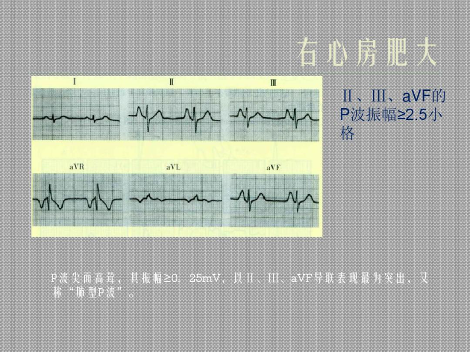 内科学诊断学重点心电图快速识图共23张课件.ppt_第3页