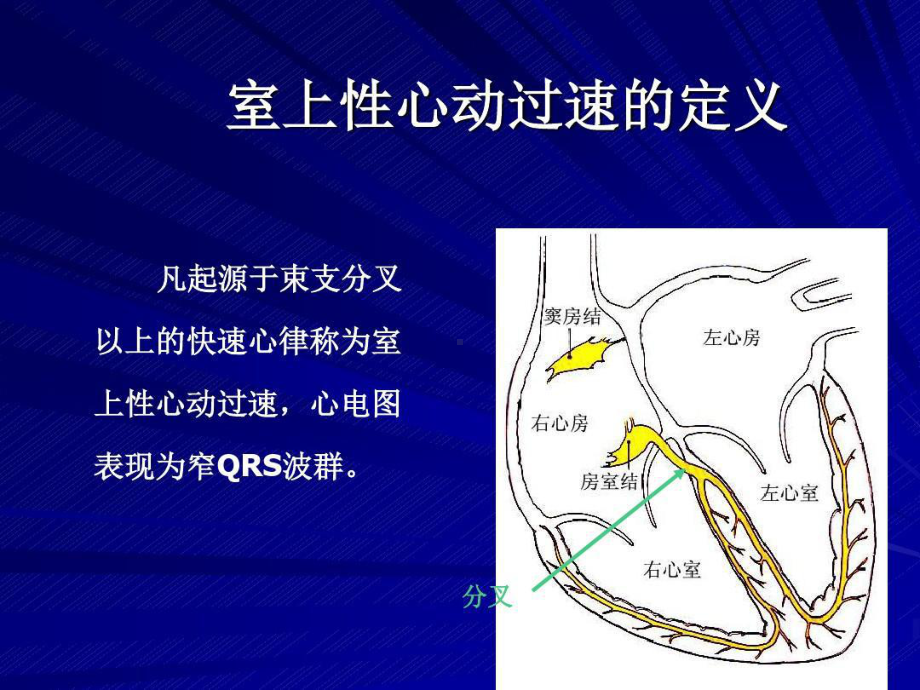 室上性心动过速鉴别诊断57张课件.ppt_第2页