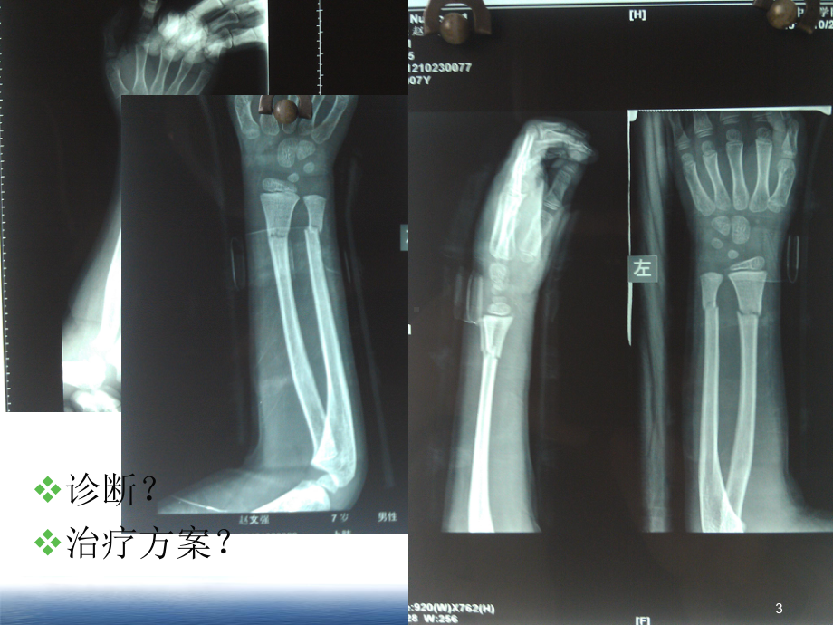 儿童闭合型尺桡骨骨折的夹板治疗课件.ppt_第3页