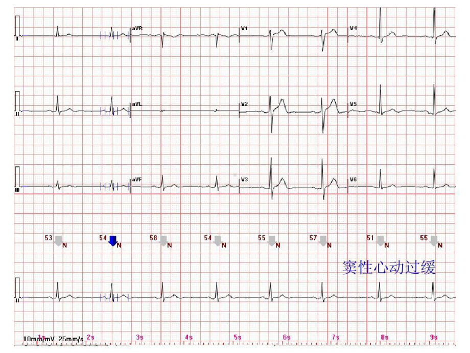 心电图常见正常和异常心电图图谱27张课件.ppt_第1页