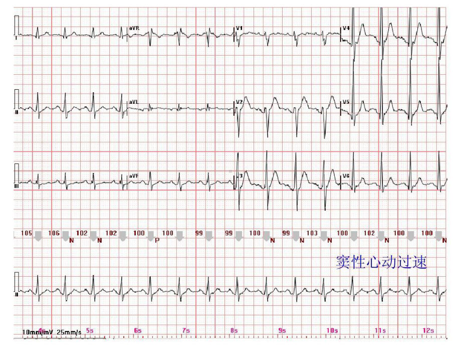 心电图常见正常和异常心电图图谱27张课件.ppt_第2页