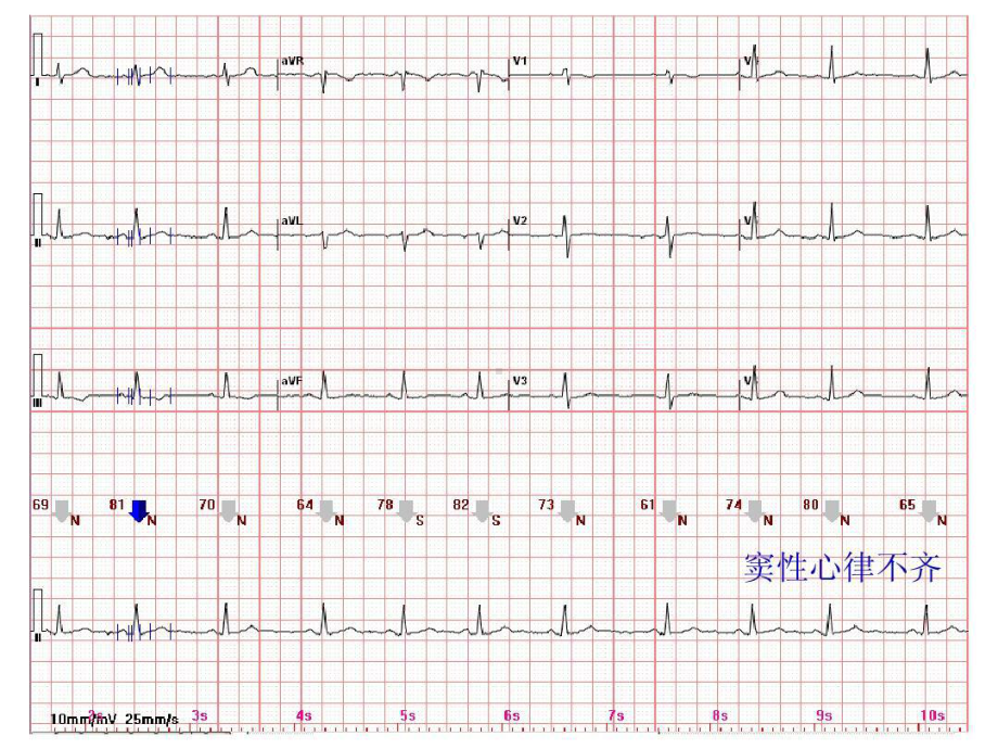 心电图常见正常和异常心电图图谱27张课件.ppt_第3页