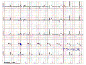 心电图常见正常和异常心电图图谱27张课件.ppt