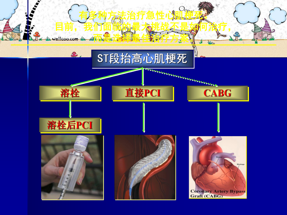 急性ST段抬高心肌梗死课件.ppt_第2页