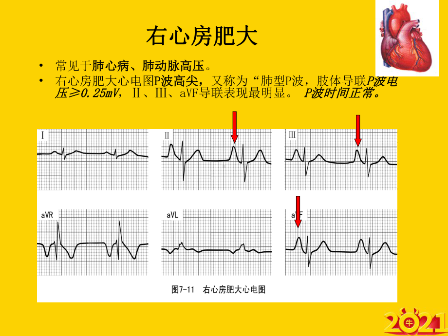 常见异常心电图正式完整版课件.ppt_第3页