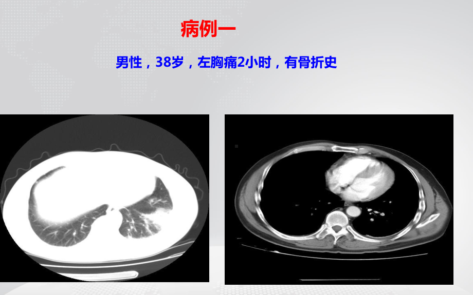 急性肺栓塞的急诊诊治策略课件.ppt_第2页