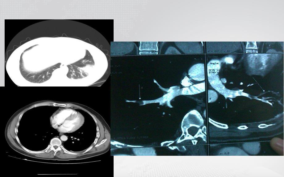 急性肺栓塞的急诊诊治策略课件.ppt_第3页