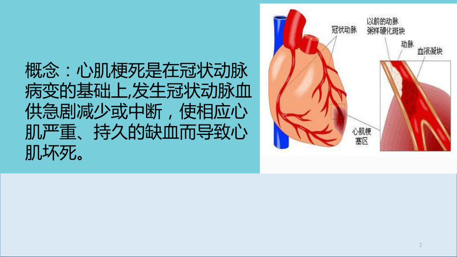 心肌梗死的护理流程课件.ppt_第2页