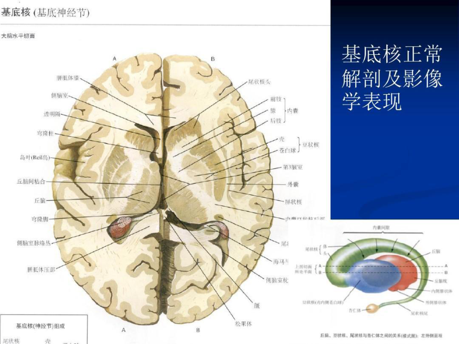 大脑深部对称性灰质核团病变的病因与MRI诊断79张课件.ppt_第3页