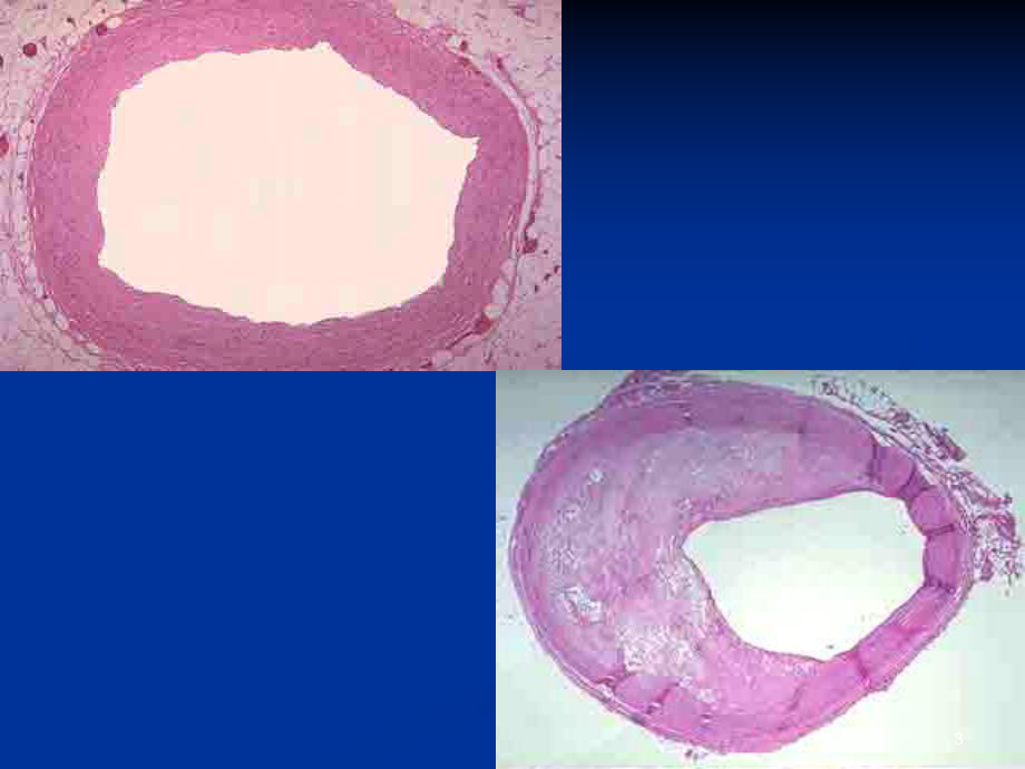 动脉粥样硬化名医课件.ppt_第3页