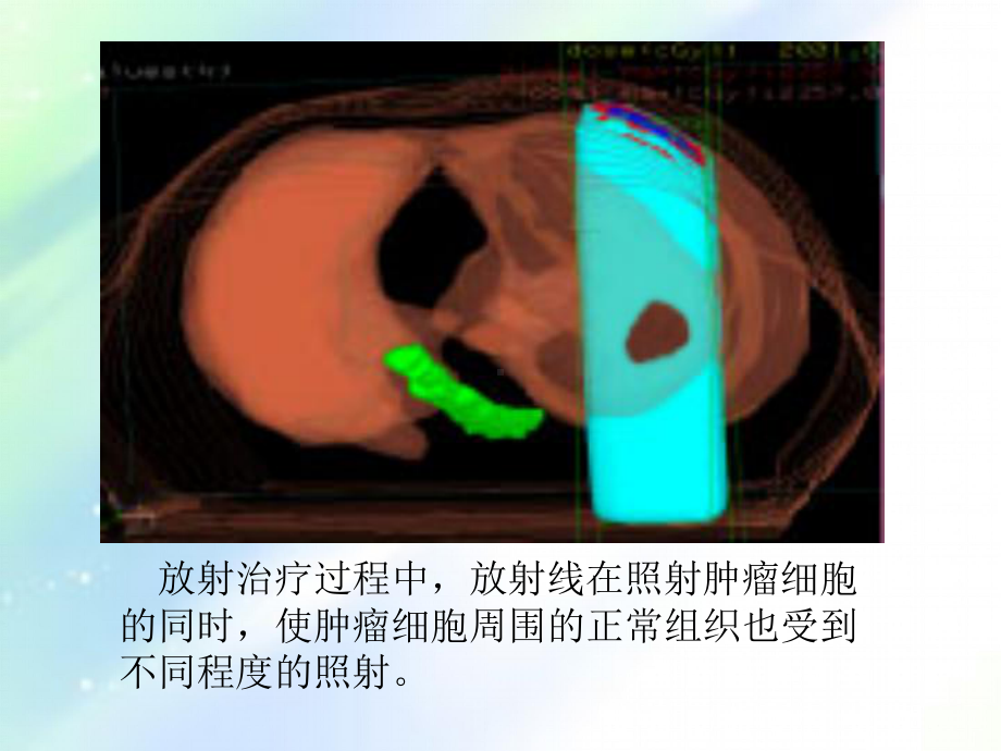 常见放射治疗技术-课件.ppt_第3页