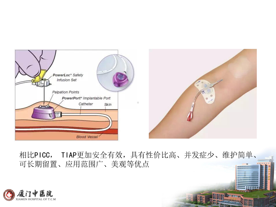 化疗神器输液港课件.ppt_第3页