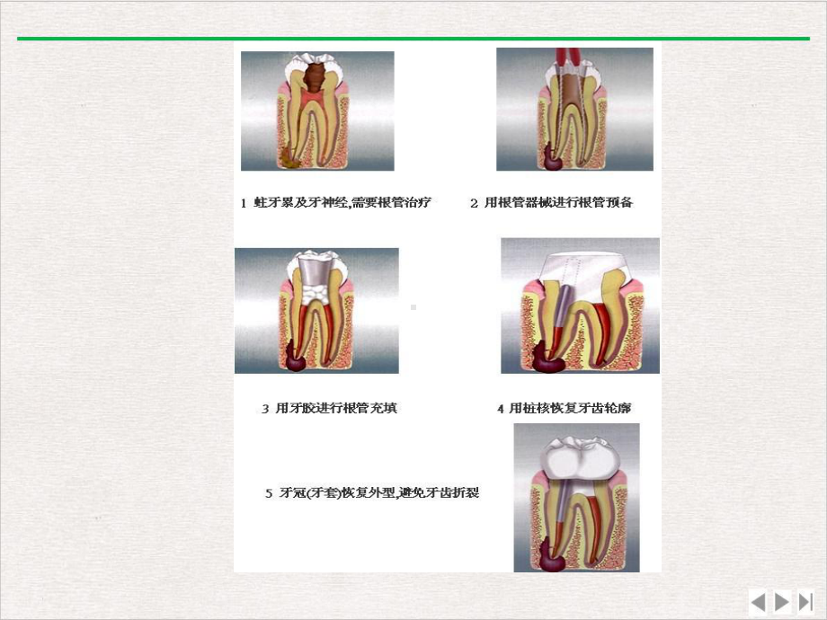 口腔内科学根管预备精选课件.ppt_第3页