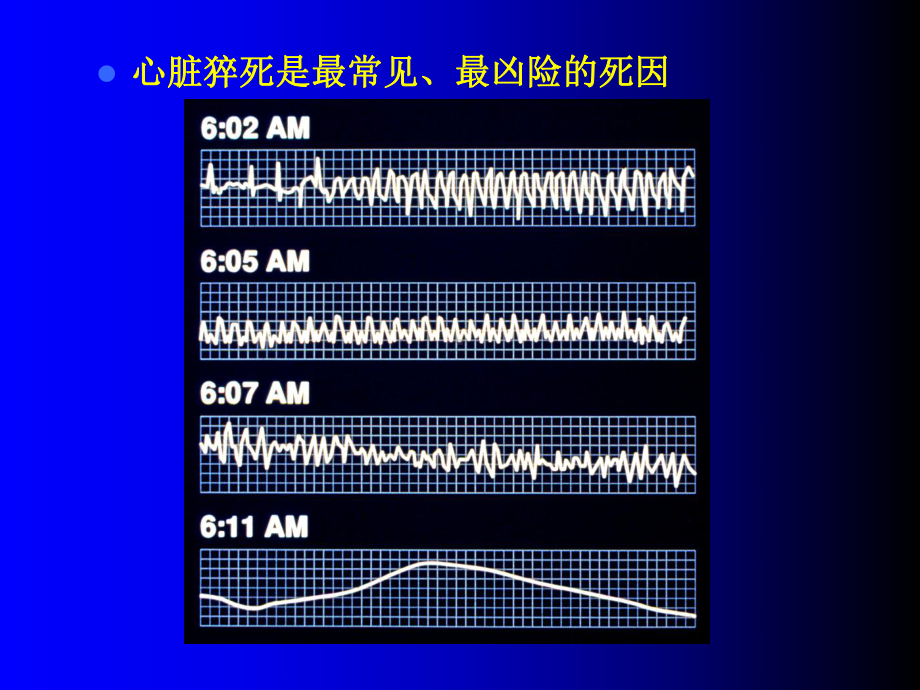 心脏骤停和心脏性猝死-VF课件.ppt_第3页