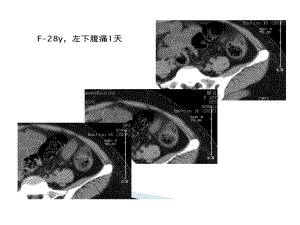 急性肠脂垂炎CT诊断共52张课件.ppt