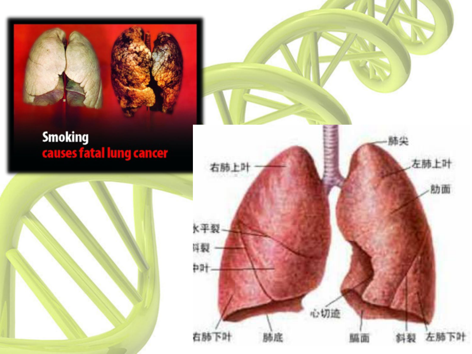 左上肺癌根治术医学课件.ppt_第3页