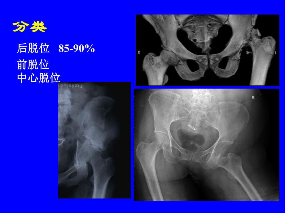 外科学多媒体课件-髋关节脱位.ppt_第3页