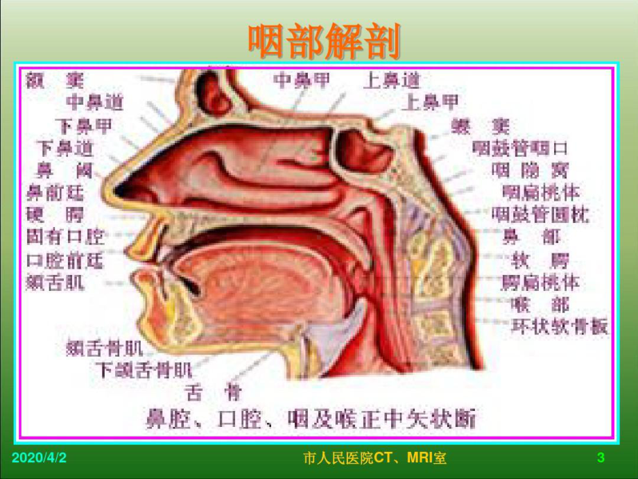 儿童腺样体肥大影像表现与诊断标准共77张课件.ppt_第3页