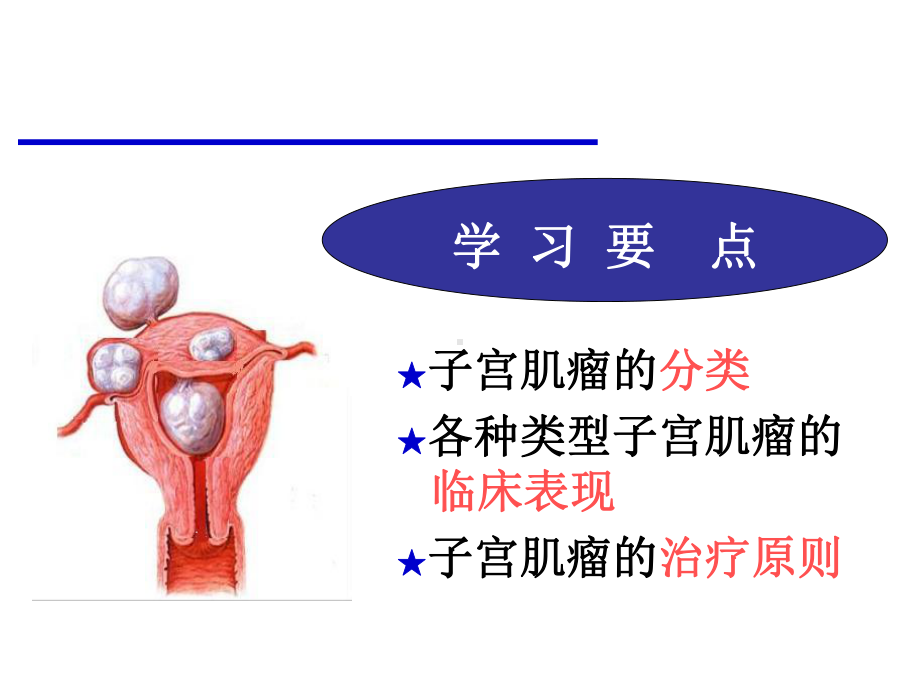 子宫肌瘤的分类和临床表现报告课件.ppt_第2页