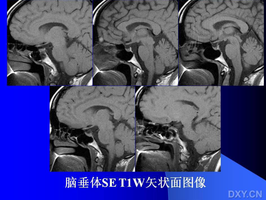 垂体瘤MR表现(课堂)课件.ppt_第3页