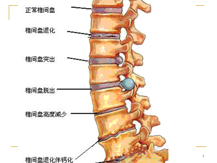 动态牵引治腰椎病课件.ppt_第3页