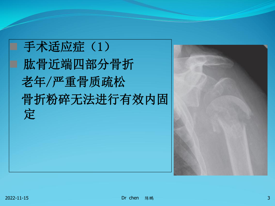 半肩关节置换临床应用-课件.ppt_第3页