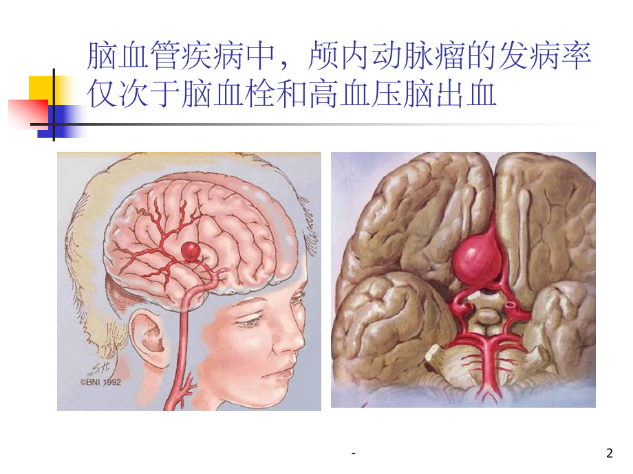 动脉瘤手术配合-课件.ppt_第2页