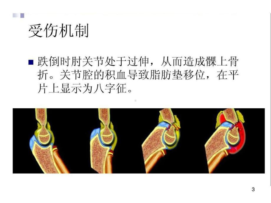 儿童肘关节骨折X线诊断79张课件.ppt_第3页