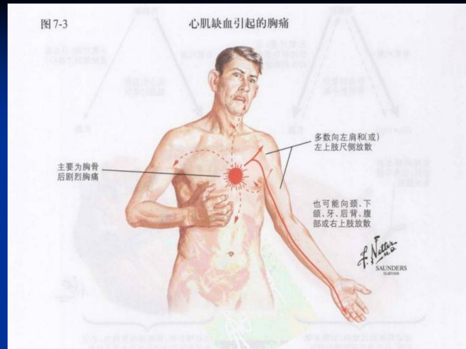 冠心病超声诊断总结课件.ppt_第3页