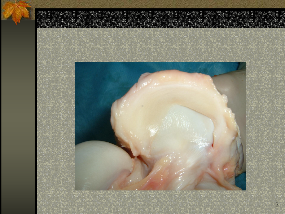 半月板损伤的MRI表现课件.ppt_第3页