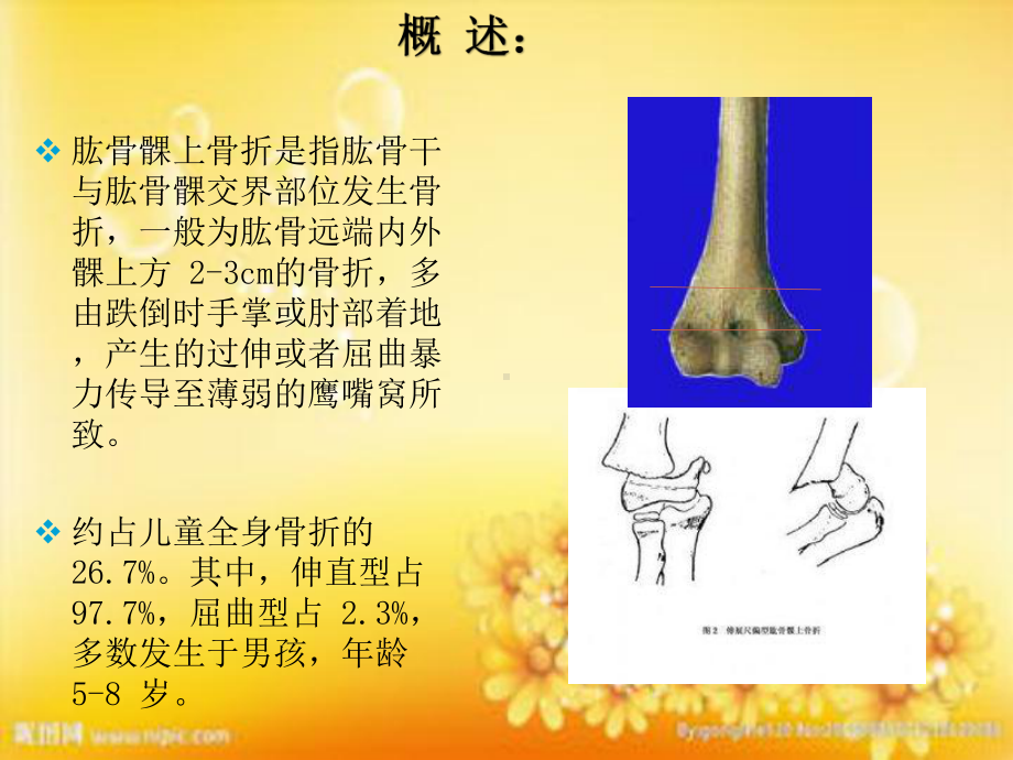 儿童肱骨髁上骨折闭合复位内固定术-课件.ppt_第2页