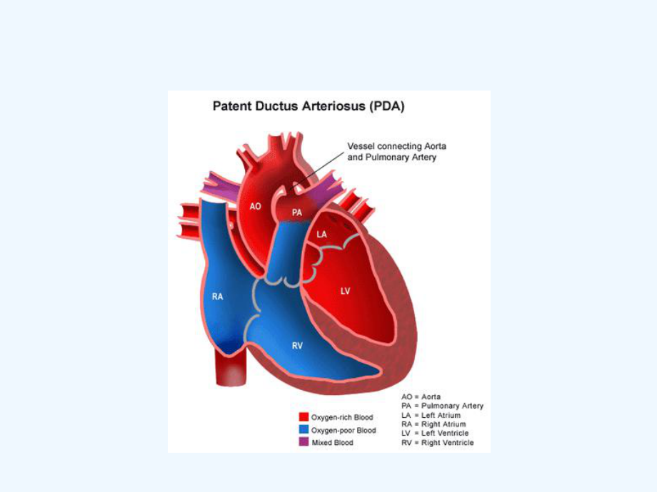 动脉导管闭合术-课件.ppt_第2页