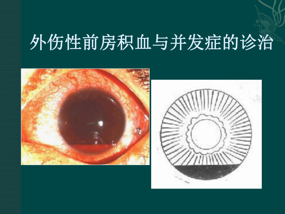 外伤性前房积血与并发症的诊治课件.ppt_第1页