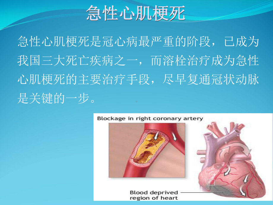 小讲课急性心梗溶栓术后并发症观察课件.ppt_第2页