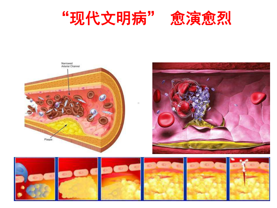 关注心血管疾病危害课件.ppt_第2页