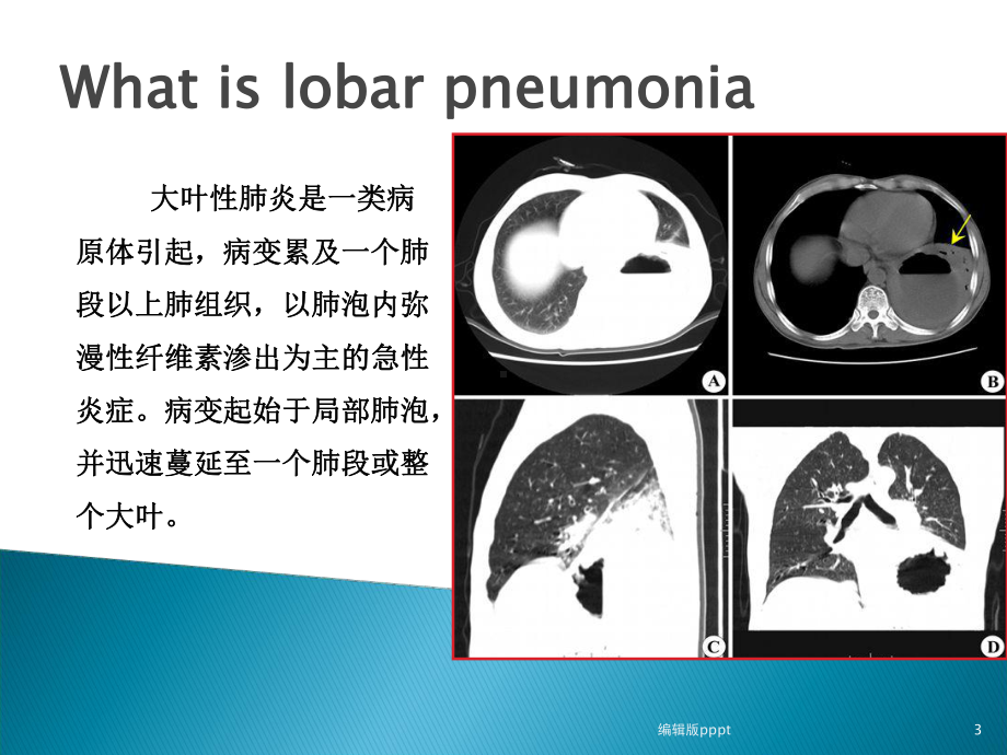 儿童大叶性肺炎70170课件.ppt_第3页