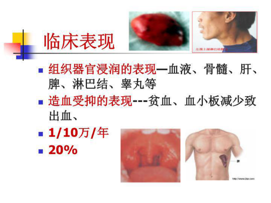 内科学-慢性髓细胞白血病18张课件.ppt_第3页