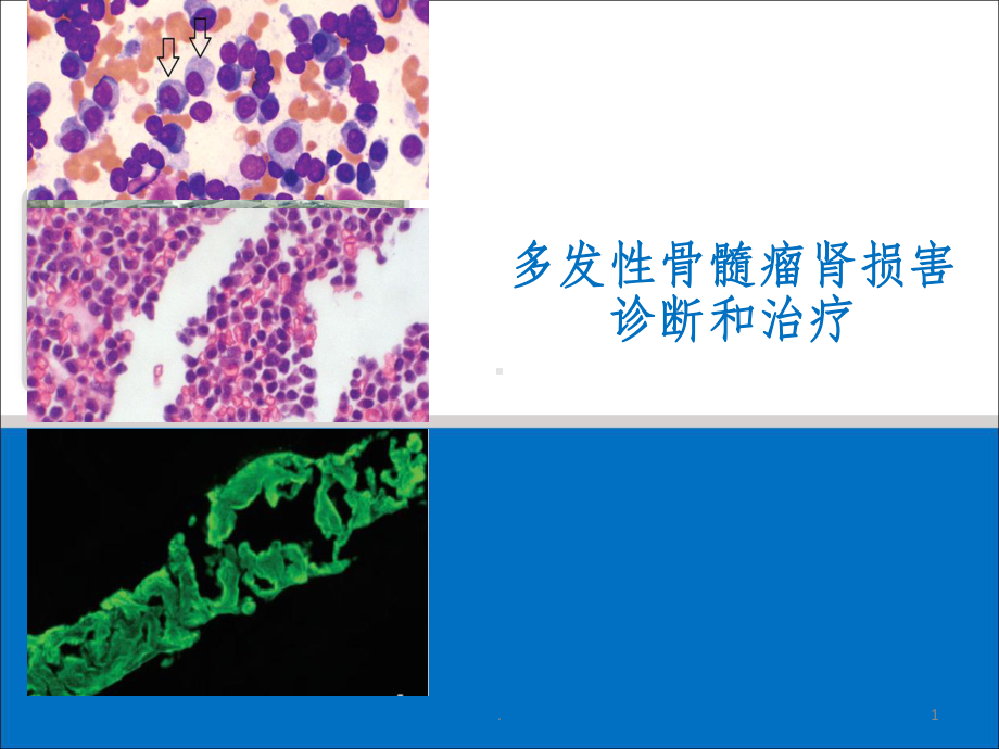 多发骨髓瘤肾损害课件.ppt_第1页