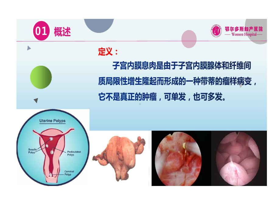 子宫内膜息肉诊断和治疗共31张课件.ppt_第3页