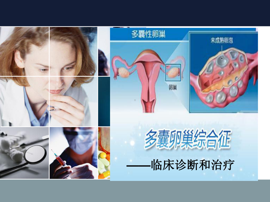 多囊卵巢综合征参考课件.ppt_第1页