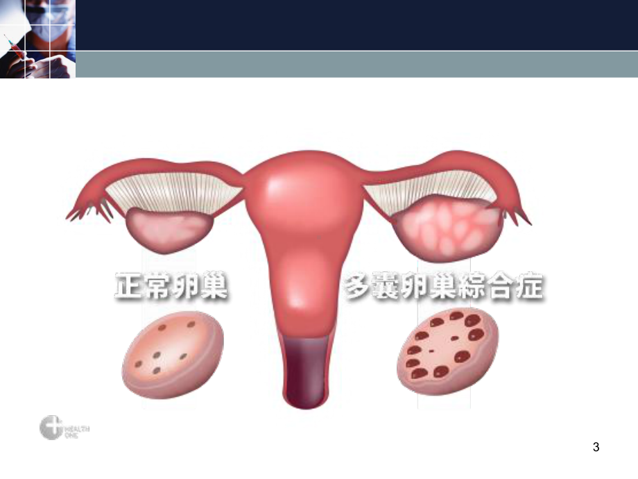 多囊卵巢综合征参考课件.ppt_第3页