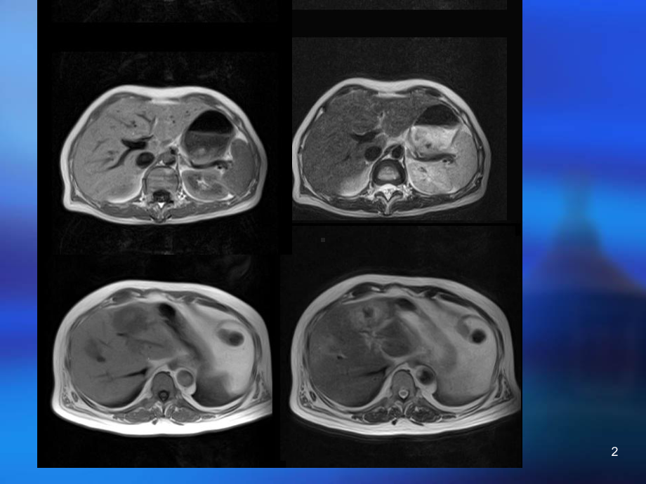 医学影像学腹部二课件.ppt_第2页