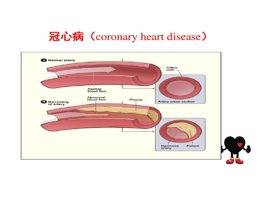 冠心病患者行非心脏手术麻醉管理共53张课件.ppt_第3页