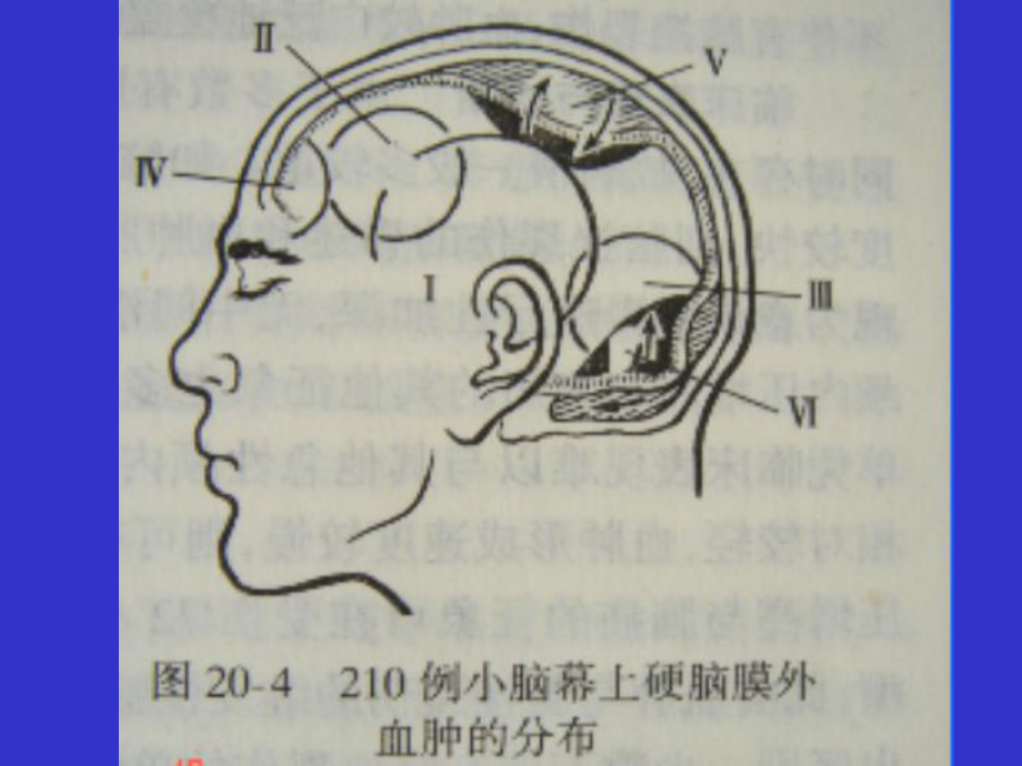 急性硬膜外血肿课件.ppt_第3页