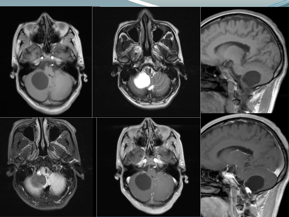 小脑四脑室区囊性病变课件.ppt_第3页