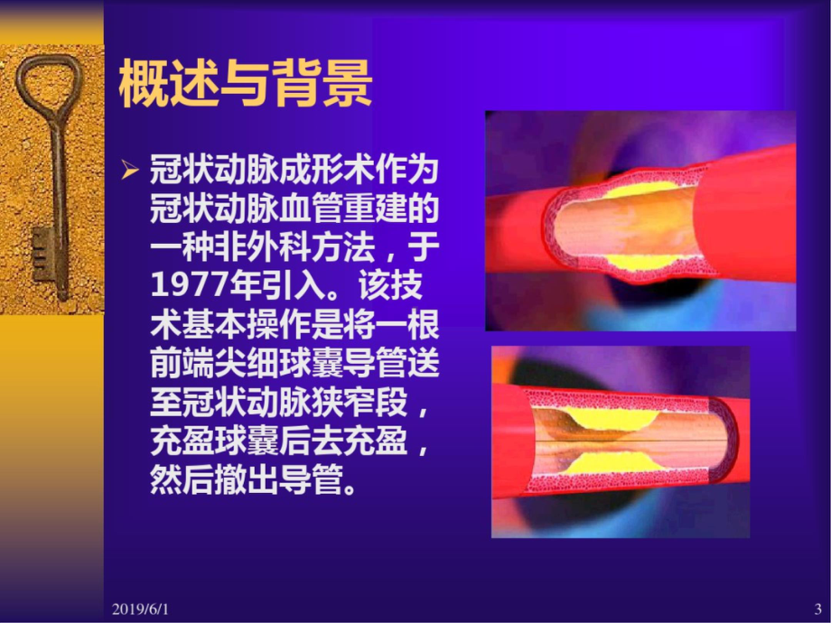 心血管疾病介入诊断治疗护理-课件.ppt_第3页