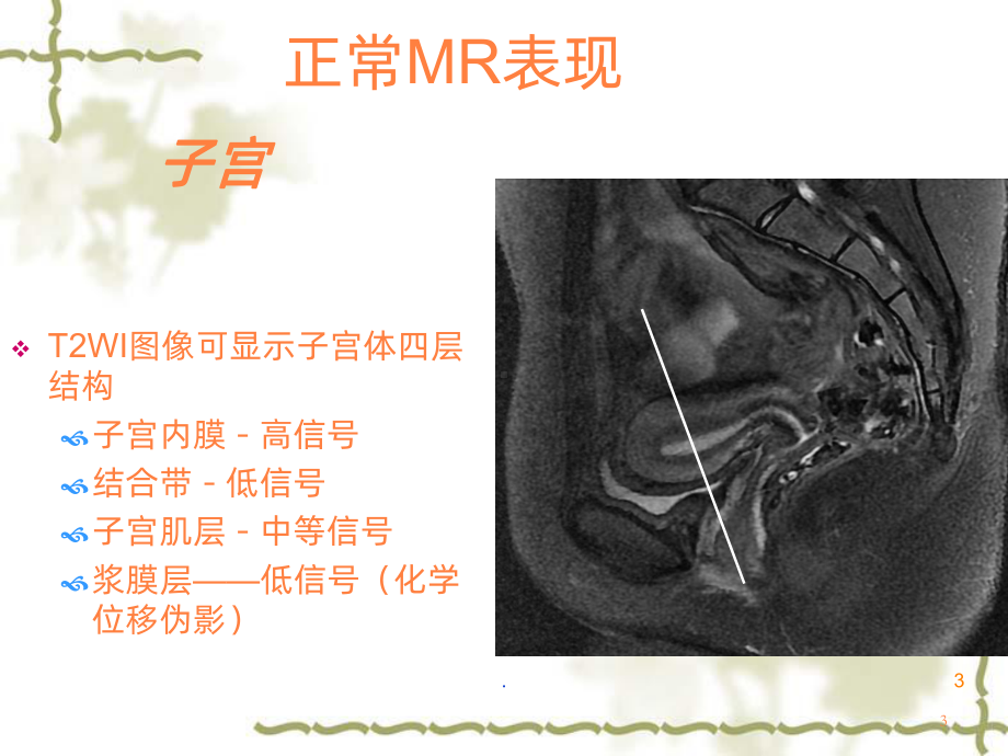 女性盆腔病变诊断课件.ppt_第3页